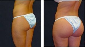 lipofilling fesses Tunisie avant apres