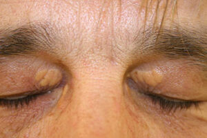 Xanthelasma c'est quoi