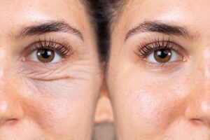 La blépharoplastie c'est quoi