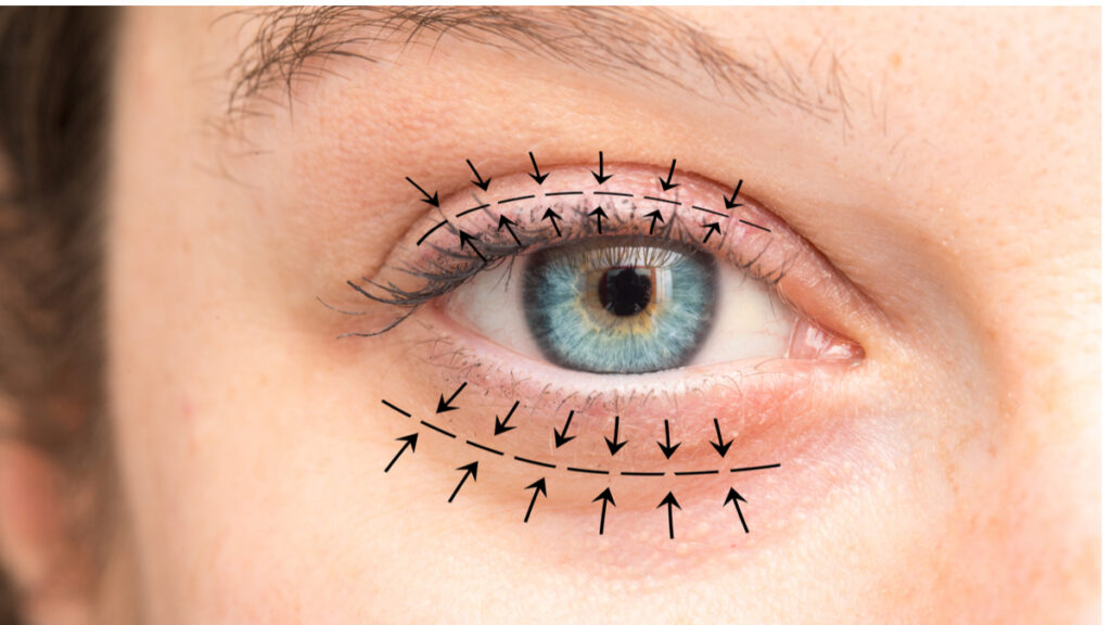Déroulement blépharoplastie