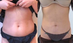 liposuccion du ventre avant après