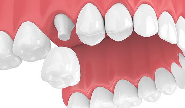 Couronne-Dent