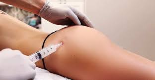 chirurgie esthetique tunisie pour augmenter les fesses sans implants
