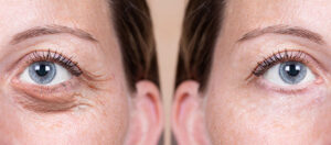 c'est quoi la blépharoplastie