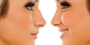 chirurgie esthétique du nez