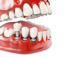 implant dentaire c'est quoi