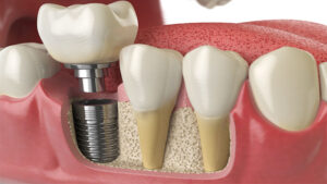 prix implants dentaires
