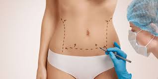 Chirurgie esthétique en Tunisie pour obtenir un ventre plat