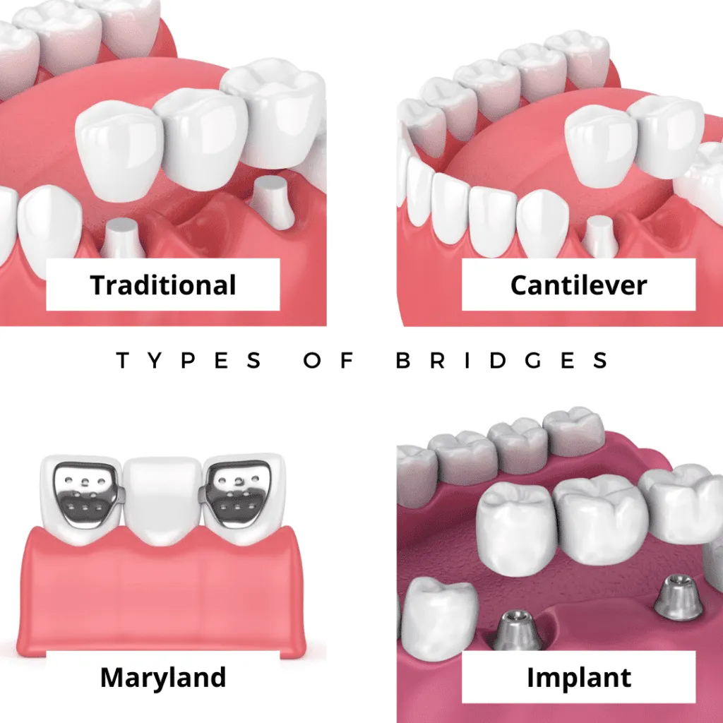 types de bridges dentaires tunisie