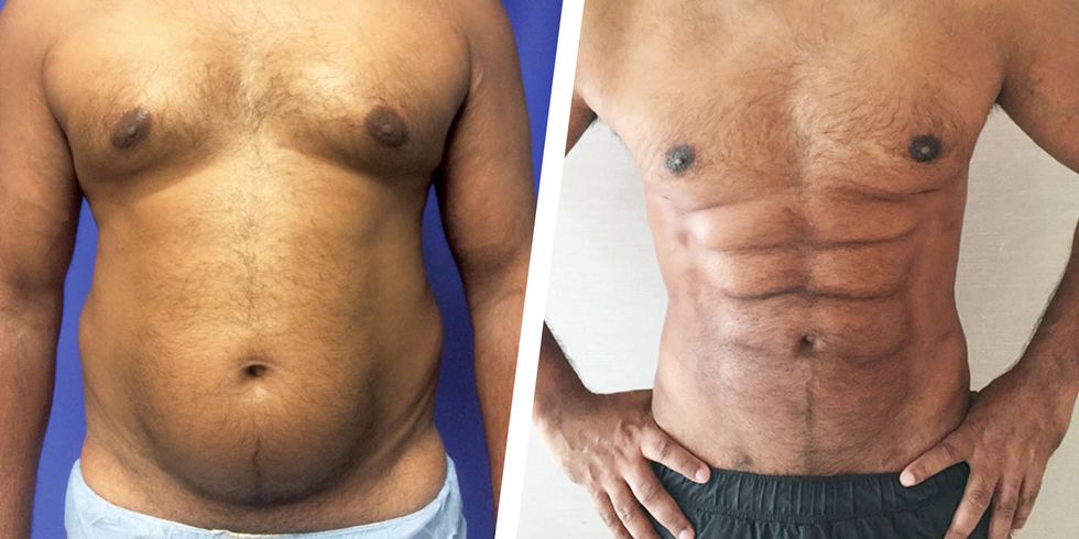 abdominal etching tunisie saouma
