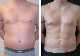 abdominal etching tunisie
