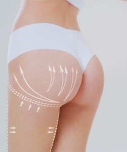 augmentation-fesses-implants-tunisie
