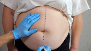 chirurgie obesite tunisie