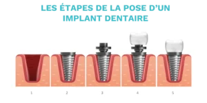 implant dentaire tunisie