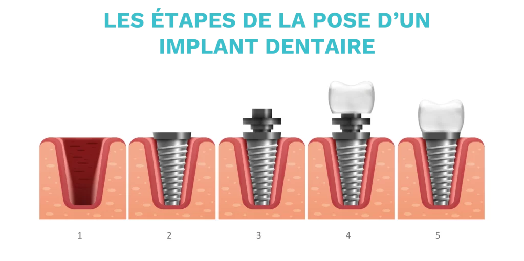 implant dentaire tunisie
