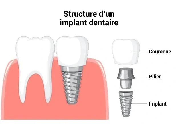 implant dentaire tunisie