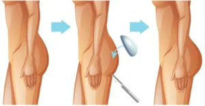 augmentation fesses implants tunisie