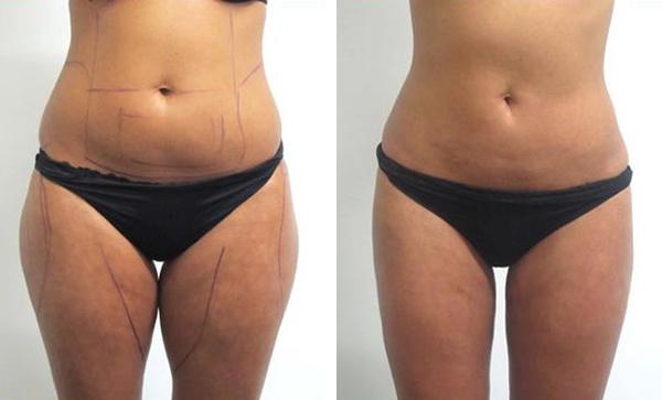 Liposuccion Haute Définition en Tunisie