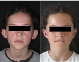 chirurgie esthetique oreilles décollées tunisie