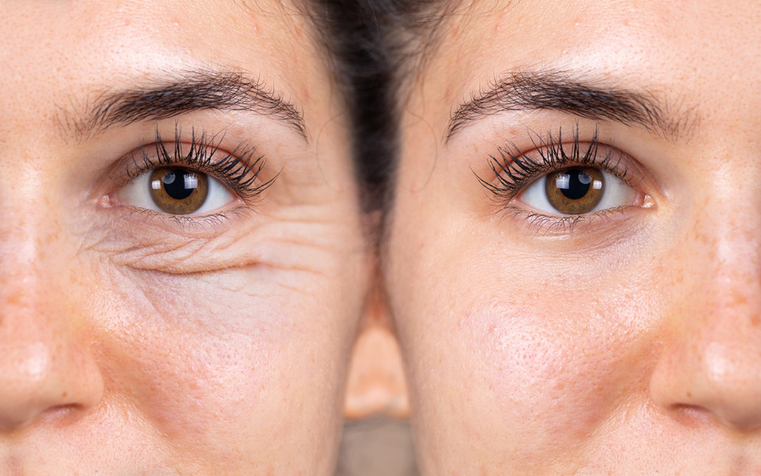 Chirurgie esthétique des paupières