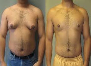 GYNECOMASTIE TUNISIE