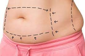 Prix de la chirurgie esthétique pour un ventre plat en Tunisie