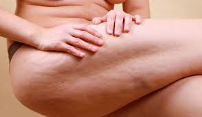 creux apres liposuccion