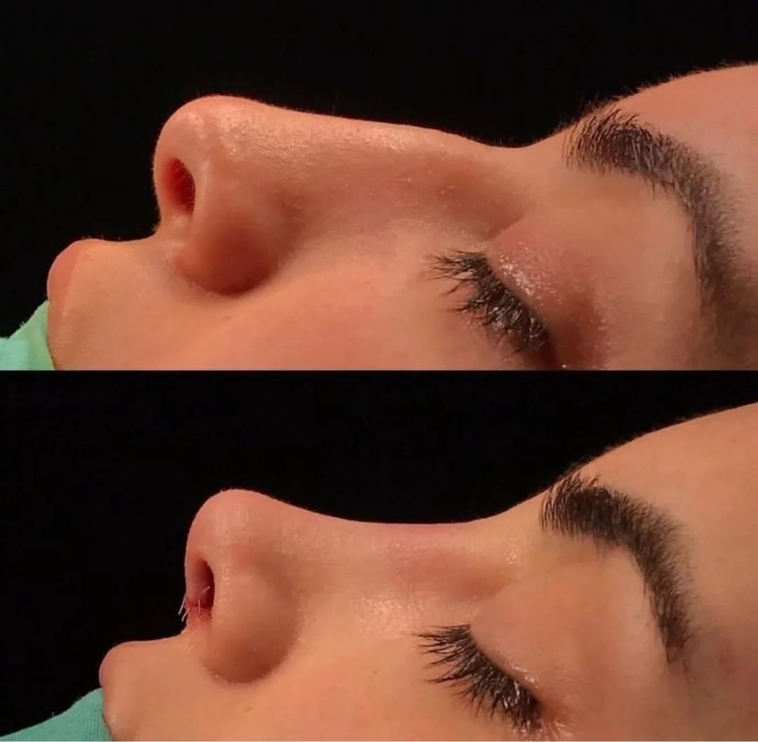 critères de succès d'une rhinoplastie en Tunisie