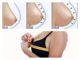 lipofilling mammaire tunisie resultats
