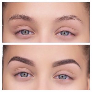 Greffe de sourcils en Tunisie