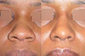 difference rhinoplastie ethnique alarplastie