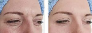 skinbooster tunisie