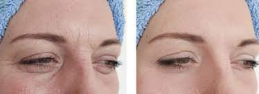 skinbooster tunisie