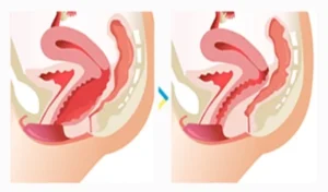 vaginoplastie tunisie