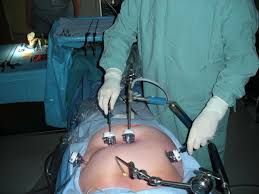 Chirurgie bariatrique en Tunisie : Une solution fiable et abordable pour retrouver la santé