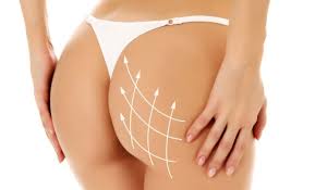 lipofilling si le volume est insuffisant