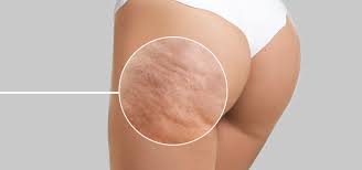 radiofréquence permet-elle d’éliminer la cellulite