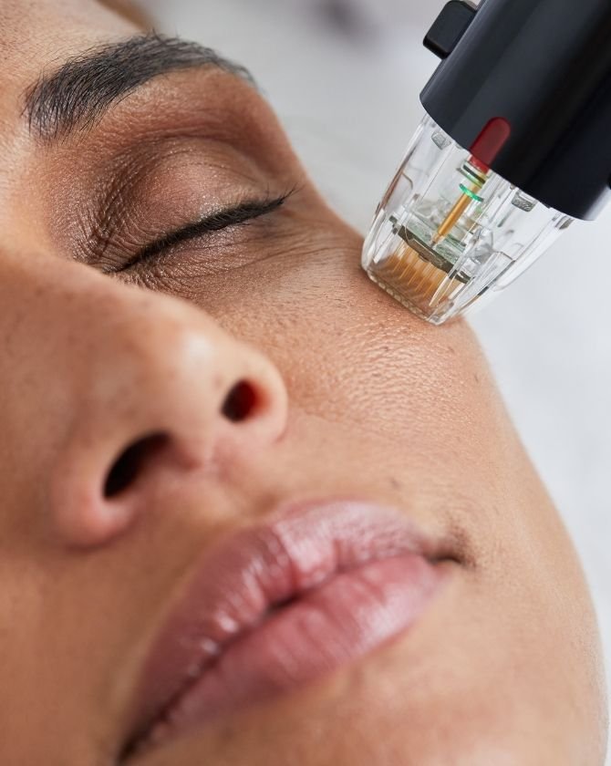radiofrequence-types-peau-