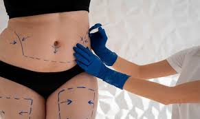 FAQ – Tout savoir sur la récupération et la constipation après une abdominoplastie en Tunisie