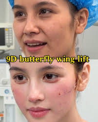 9d butterfly wing lift tunisie