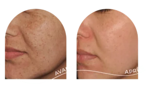 Traitement des taches pigmentaires