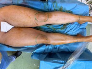 récupération après une chirurgie du lipœdème
