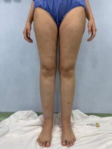 récupération après une chirurgie du lipœdème