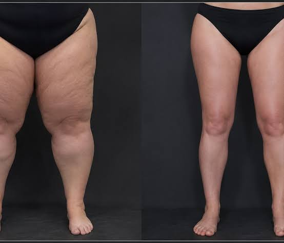dr-gam-lipoedeme-total-definer